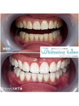 ホワイトニングサロン 名古屋駅店/【ホワイトニング施術例】