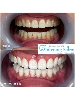ホワイトニングサロン 名古屋駅店/【ホワイトニング施術例】