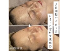 アンリミット(Unlimit)/シミケア8回のビフォーアフター