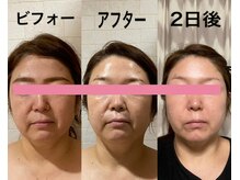 サロンドミジュ(Salon de 美jyu)/小顔・骨格矯正　T様　50代