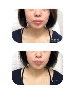 サロン ド ラヴィエール(salon de Laviere)/表情筋ケアでお顔リフトアップ