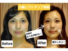 ラ コンシェル 武蔵小杉店/リフトアップ美鍼、お客様の結果