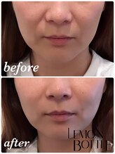 アリミリサロン(A.Rimi.Ri salon)/レモンボトル