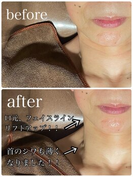 イーストモア(EAST MOIS)/首まで光を当てます☆