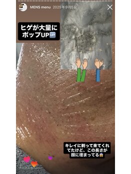 シェーングランツ(SchonGlanz)の写真/【50代～10代の学生さんまでリピート中！】毎日のひげ剃り卒業しませんか?清潔感のあるモテ肌で第一印象UP!