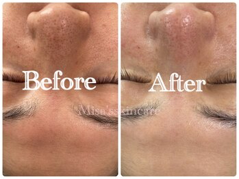 ミサズ スキンケア(misa's skin care)/ビフォー/アフター 20代