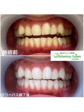ホワイトニングサロン 名古屋駅店/【ホワイトニング施術例】