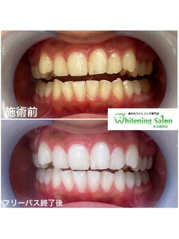 ホワイトニングサロン 名古屋駅店/【ホワイトニング施術例】