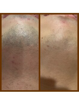 リアンジュ/ヒゲ脱毛の経過