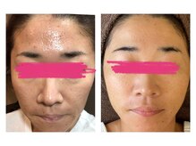 ヴィヴ コレビ(VIV COREBI)/コンプレックスもツルツル肌に