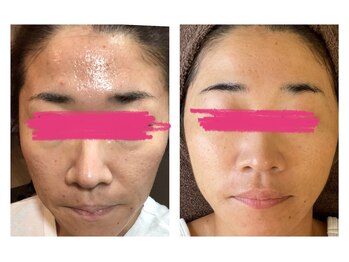 ヴィヴ コレビ(VIV COREBI)/コンプレックスもツルツル肌に