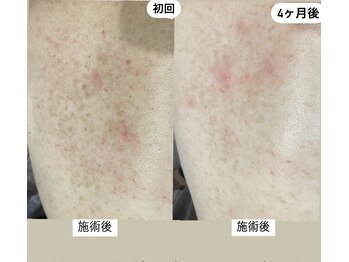 フルール(Fleur)/■背中トリートメント■