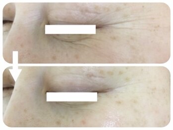 フェイシャルエステ エムズルーム(M's room)/目元用ポレーションで集中ケア