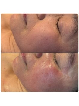 ティエット(tiet)/ハーブピーリング