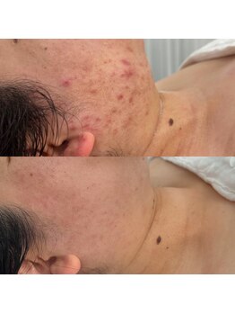 ラテプラス(LATEE＋)/何を試してもダメだった方も是非