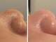 リジュベ(Rejuve)の写真/男女大歓迎！施術後の変化に大満足する方続出！頑固な毛穴悩みを徹底ケア！毛穴レスな卵肌に◎