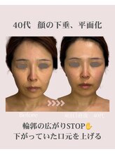 アンジェリカ(Angelica)/40代/顔の下垂や平面化/中顔面