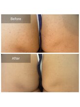 ビビ(VIVI)/お尻のケアにハーブピーリング