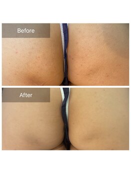 ビビ(VIVI)/お尻のケアにハーブピーリング