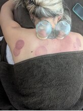 リデザイン 京都(REDESIGN)/中医カッピング療法