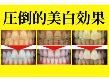ホワイトニングショップ 北四番丁店の写真/【圧倒的美白効果★結果重視の方へ】歯科提携×仙台最長40分照射で黄ばみ徹底アプローチ！コスパ仙台最大級