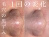 【毛穴の黒ずみ・汚れ・たるみ】毛穴洗浄+ハーブピーリング+顔脱毛