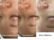 ミサズ スキンケア(misa's skin care)/ビフォー/ビフォー 20代　