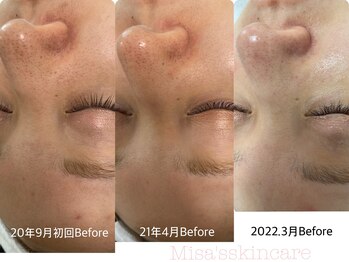 ミサズ スキンケア(misa's skin care)/ビフォー/ビフォー 20代
