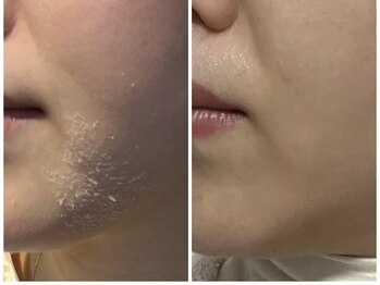 リリオ(Lirio.)/ハーブピーリング