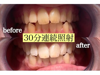 プラスビーセルフ(+b self)/30分連続照射*ホワイトニング