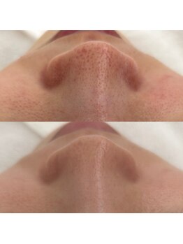 千歳の女神 久屋大通店/【施術風景】Berore/After