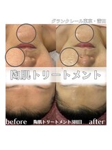 グランクレール トウキョウ(GRANDCLAIRE.TOKYO)/陶肌トリートメント