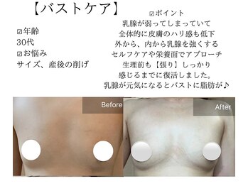 サロンツキ(salon tuki)/バストケア/症例
