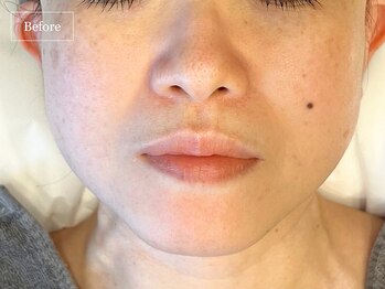 キュレイテッドスキン(CURATED SKIN)/ピーリング/毛穴ケア/リンパ