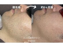 ノビシロホワイトニング(nobi-SHIROホワイトニング)/ヒゲ光脱毛