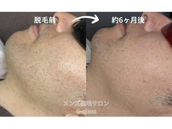 ノビシロホワイトニング(nobi-SHIROホワイトニング)/ヒゲ光脱毛