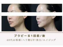 ルナビューティー 赤坂(LUNA beauty)/進化版プラピール