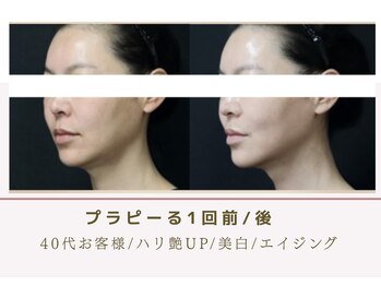 ルナビューティー 赤坂(LUNA beauty)/進化版プラピール