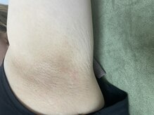 ナノハナ/鹿沼市全身脱毛美容室ナノハナ