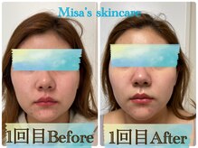 ミサズ スキンケア(misa's skin care)/ビフォー/アフター　20代