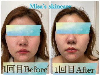 ミサズ スキンケア(misa's skin care)/ビフォー/アフター 20代