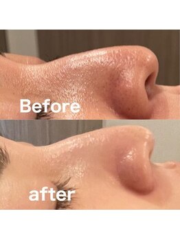 プルネ(Purune)/ハイドラフェイシャル＊毛穴ケア