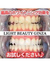 ライトビューティー 銀座店(LightBeauty)/東銀座　ホワイトニング症例写真