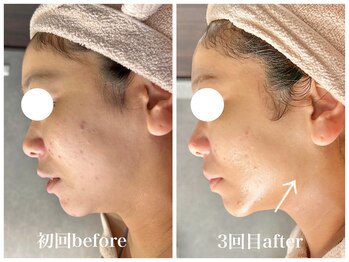 ルー ハナレ 神戸岡本 摂津本山店(Luu HANARE)/フェイスライン　肌質改善