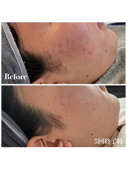 ピュア 川越店/ニキビ徹底ケアコース