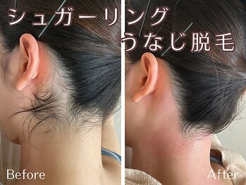 シエナ(ciena)/うなじ症例写真♪