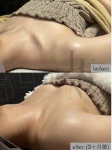 ルノン(Lunon)/バストアップ