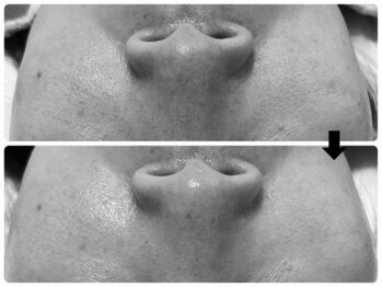 エフェクト 塚口店(effect)/Before After 40代/2回目