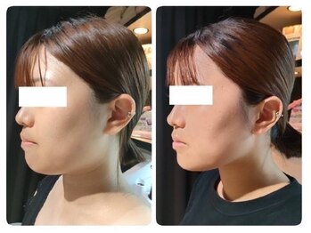 アンシャンテ(Anchant)/レモンボトル１回（２週間後）