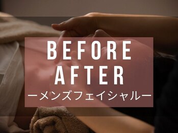 メディカルエステサロン ローズ 金沢本店(ROSE)/メンズFビフォーアフター